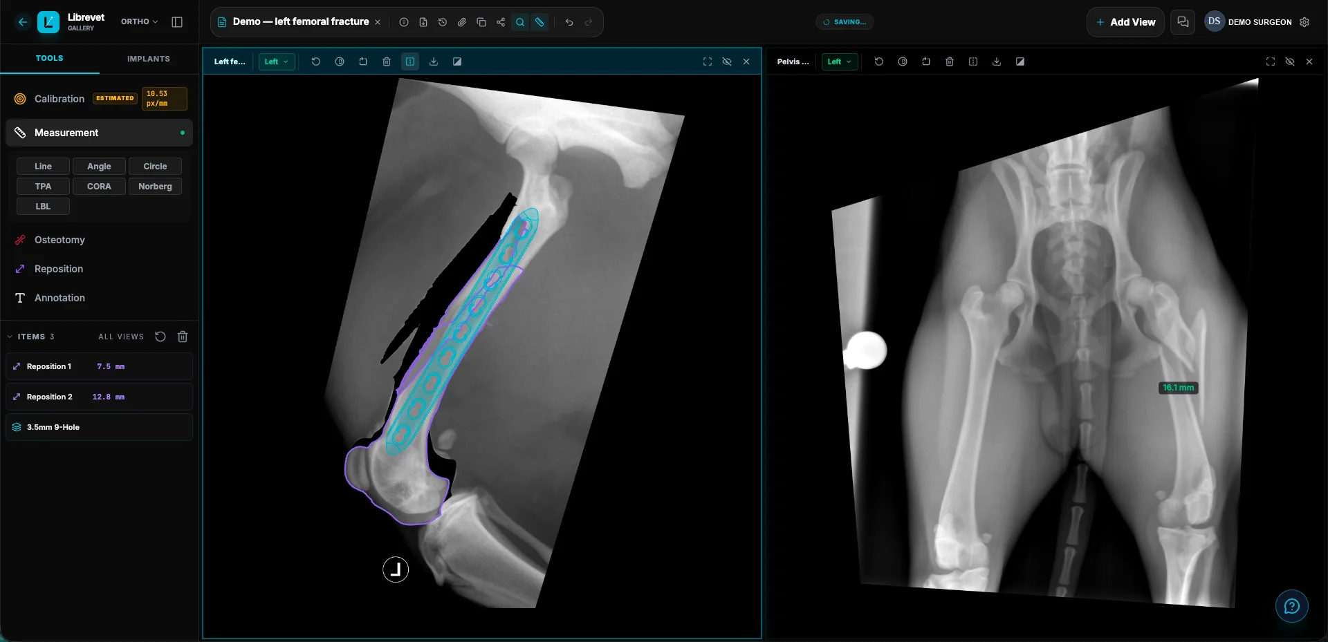 Librevet Ortho 2D planning a left femoral fracture: the fragments repositioned by 7.5 mm and 12.8 mm, a 3.5 mm nine-hole plate templated across the repair at true scale, and a pelvic view alongside.