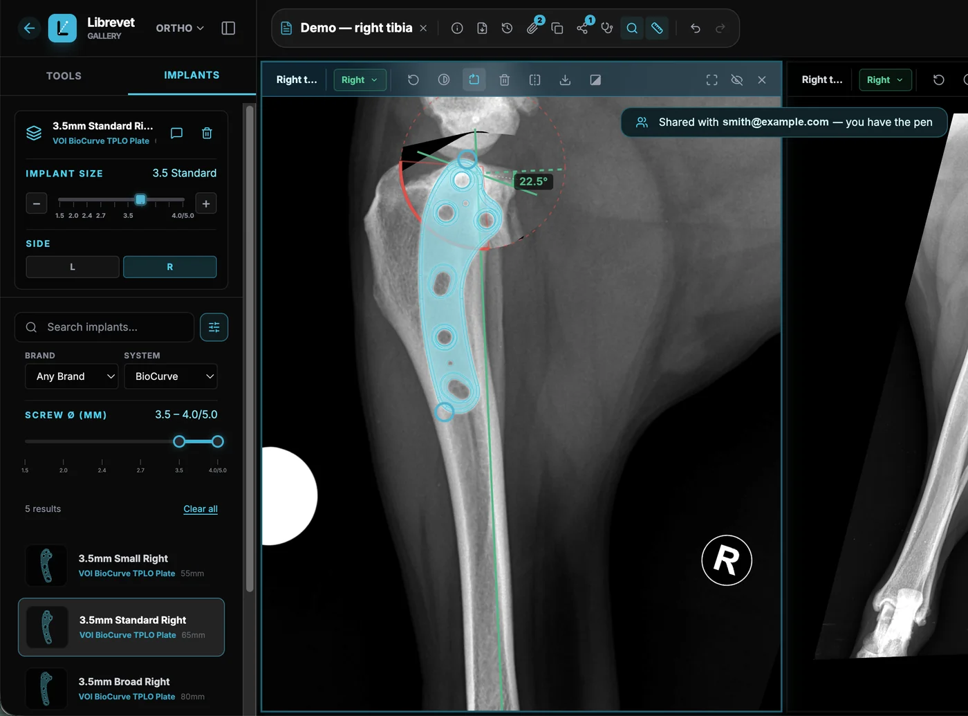 Librevet Ortho 2D with the implant panel open: a size range and side selector, brand and system filters, and three VOI BioCurve TPLO plates listed at 55, 65 and 80 mm — with the selected plate overlaid at true scale on a right tibia beside a tibial plateau angle of 22.5 degrees.