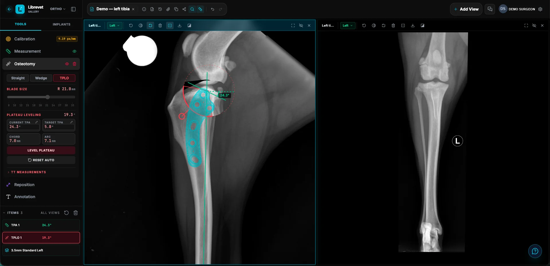 Librevet Ortho 2D planning a TPLO on a left tibia: the tibial plateau angle measured at 24.3 degrees, a target of 5 degrees set, a 21 mm osteotomy arc placed on the radiograph and a 3.5 mm plate overlaid at true scale, with a second view alongside.
